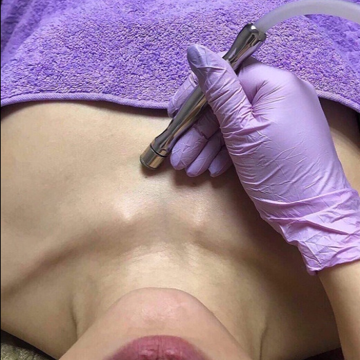 Алмазный пилинг зоны шеи и декольте