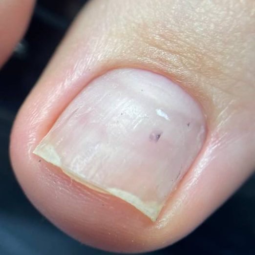 Гигиеническая обработка стопы и пальчиков. Возможно покрытие обычным лаком