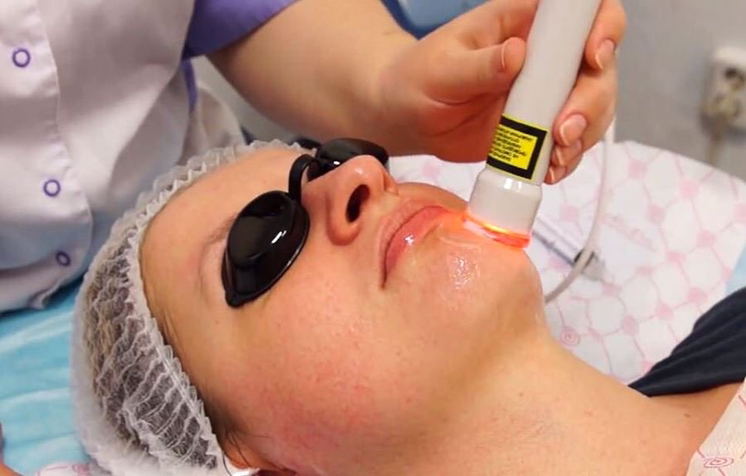 Лазерная биоревитализация