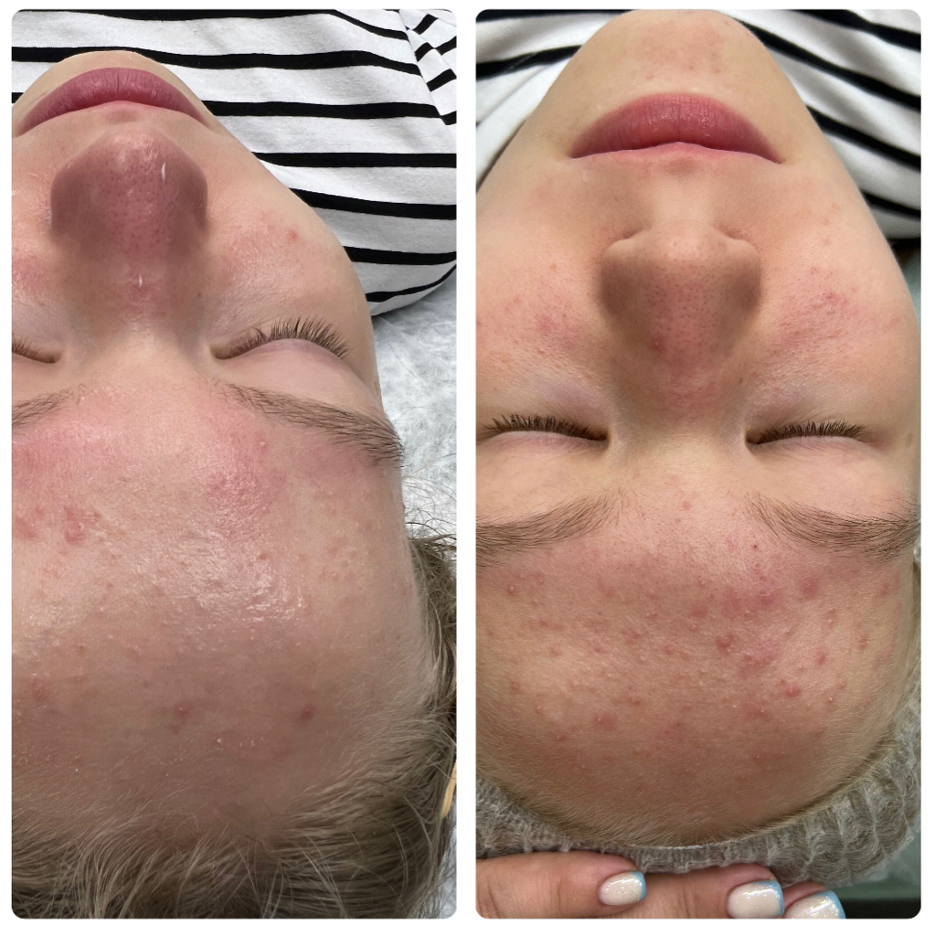 Чистка лица - подростковая 11+