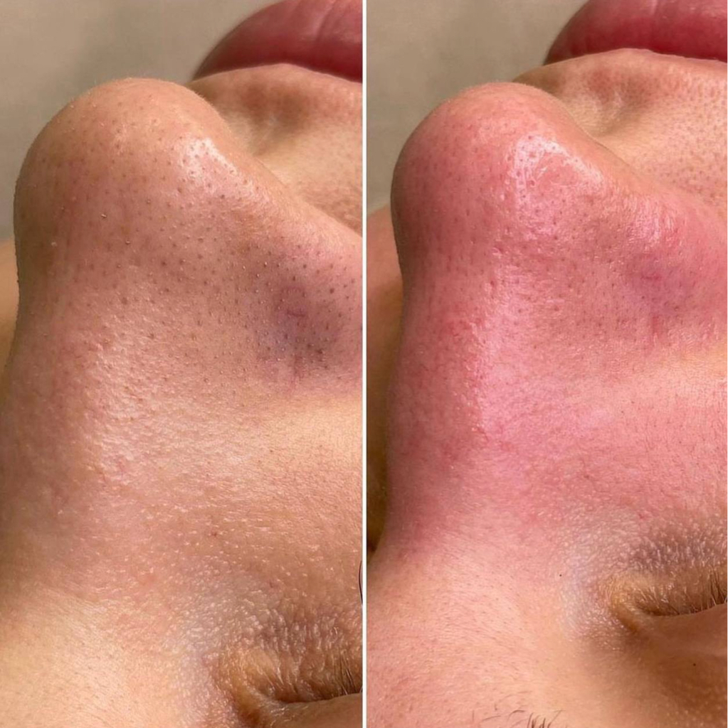 Чистка лица классическая 18+