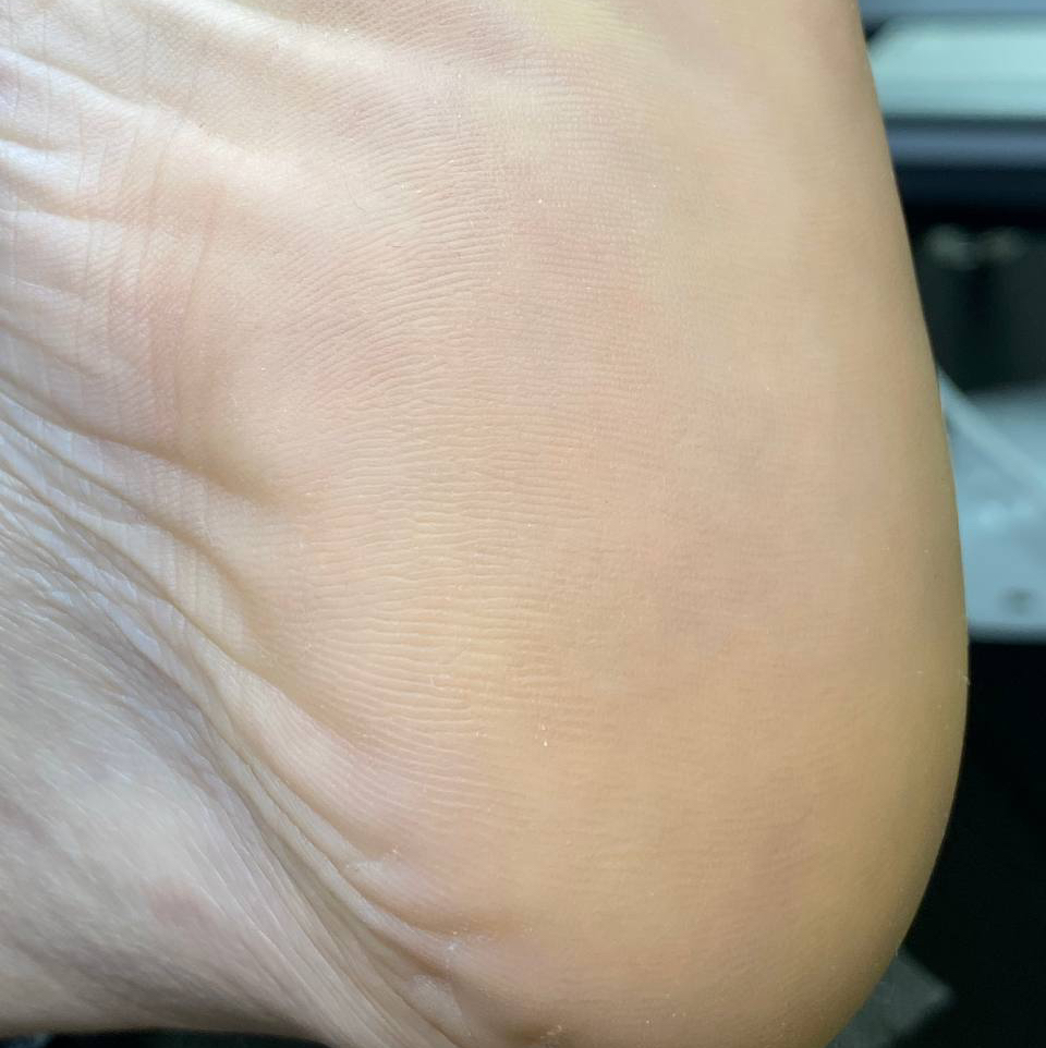 Обработка пяточек