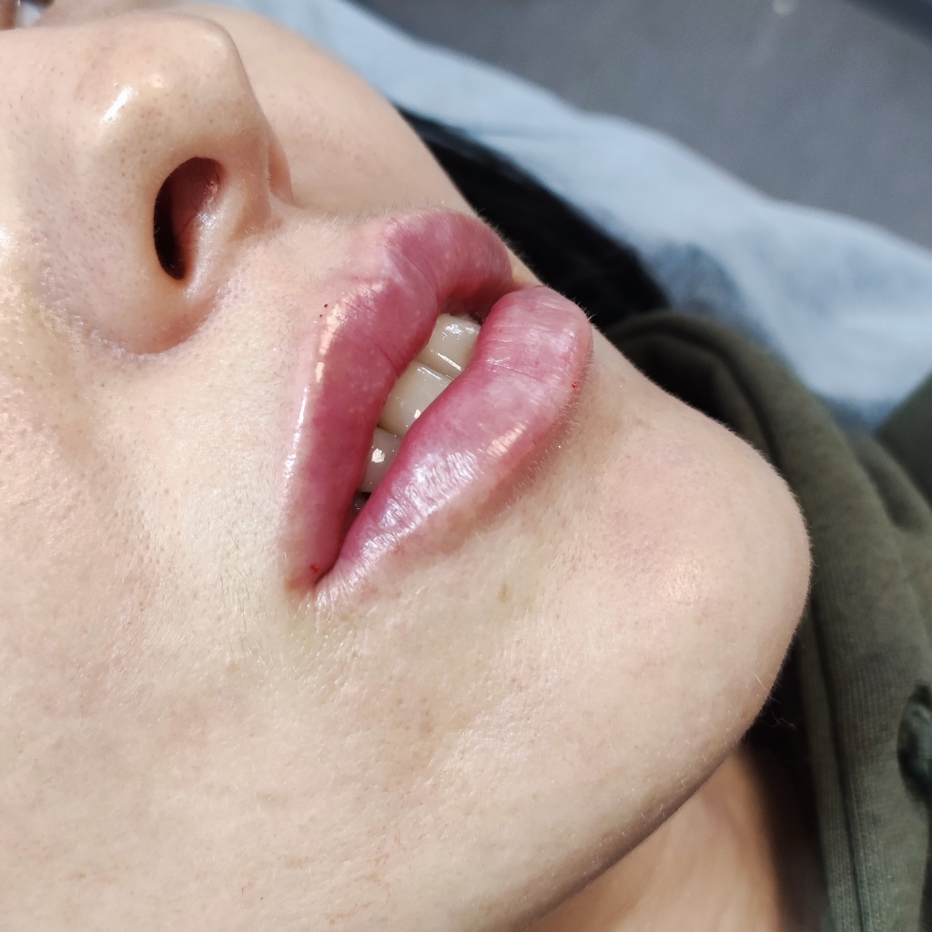 контурная пластика губ