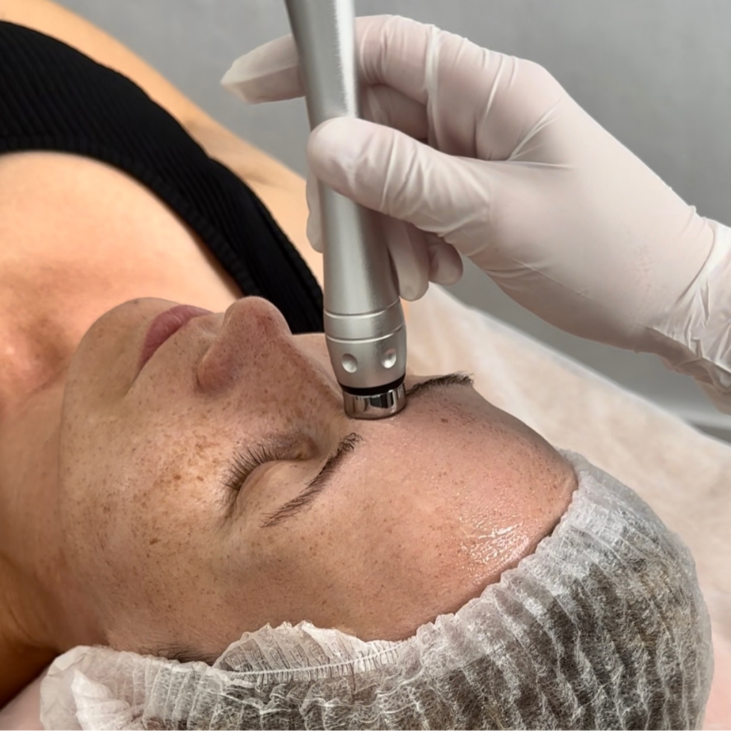 RF-ЛИФТИНГ | уплотнение возрастной кожи