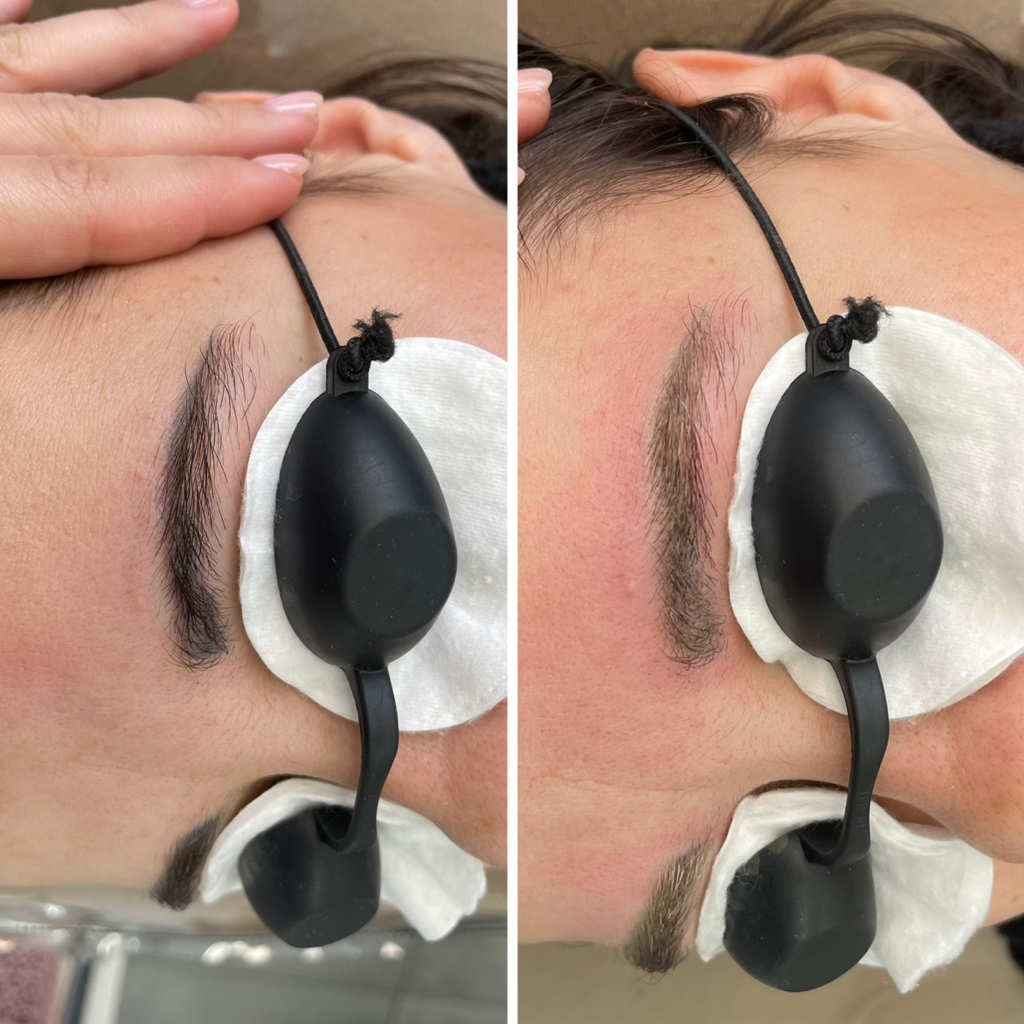 Лазерное удаление татуажа