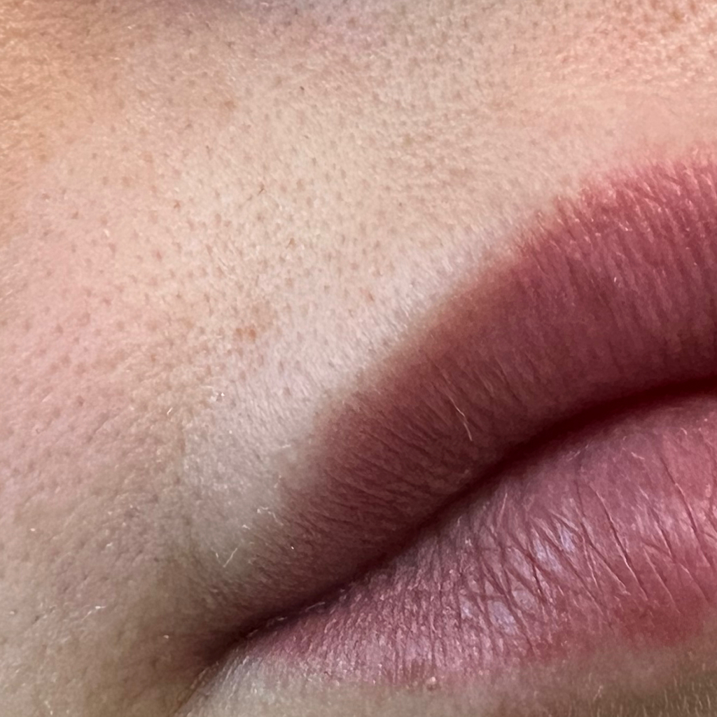 Удаление пушка над губой