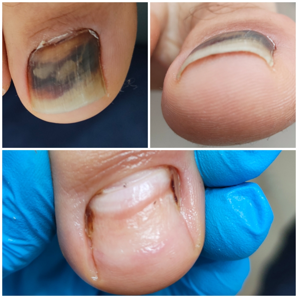 Первичная обработка травмированного ногтя на ноге