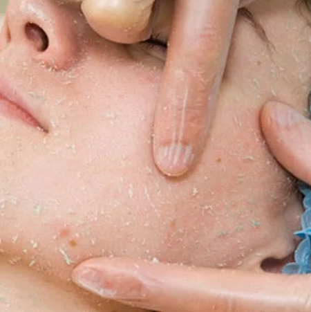 Пилинг- скатка