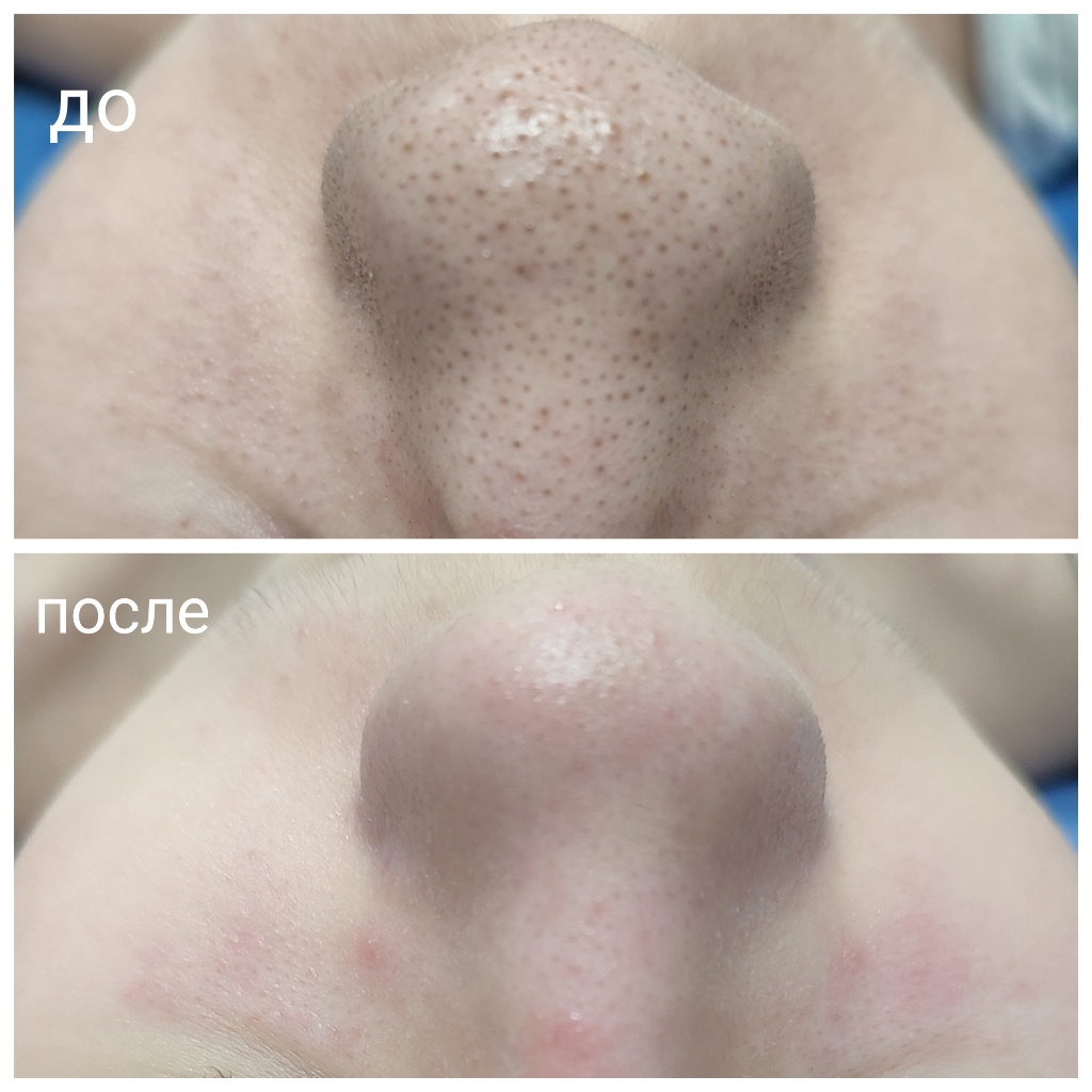 .  7- этапная атравматичная чистка лица