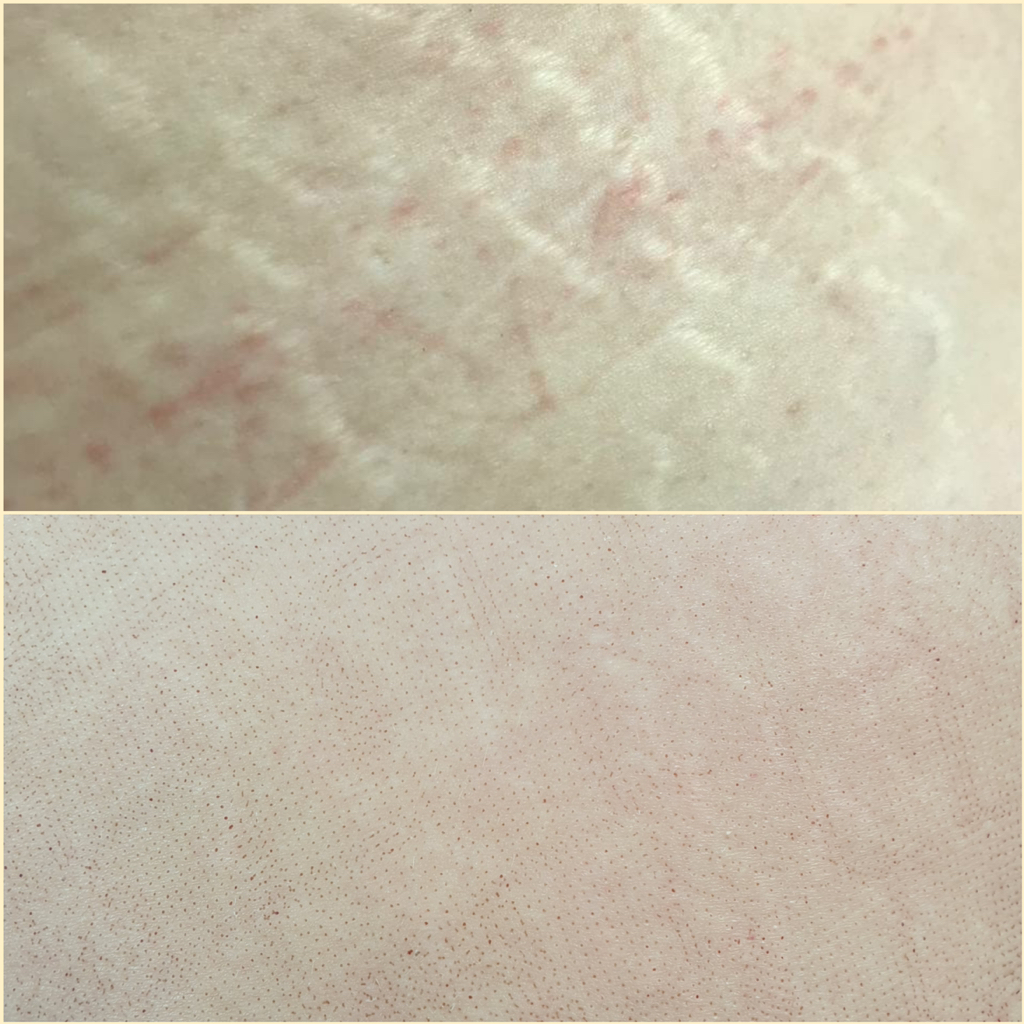 Лазерная шлифовка растяжек