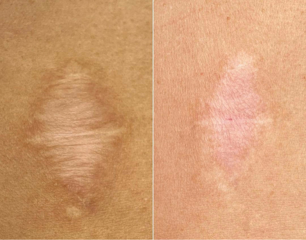 Лазерная шлифовка  шрамов, рубцов